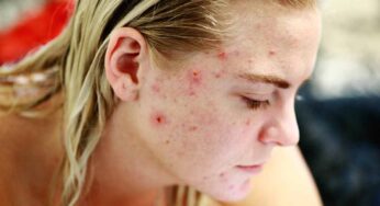 Questi comuni alimenti rendono la tua pelle molto più brutta: dovresti smettere subito di mangiarli